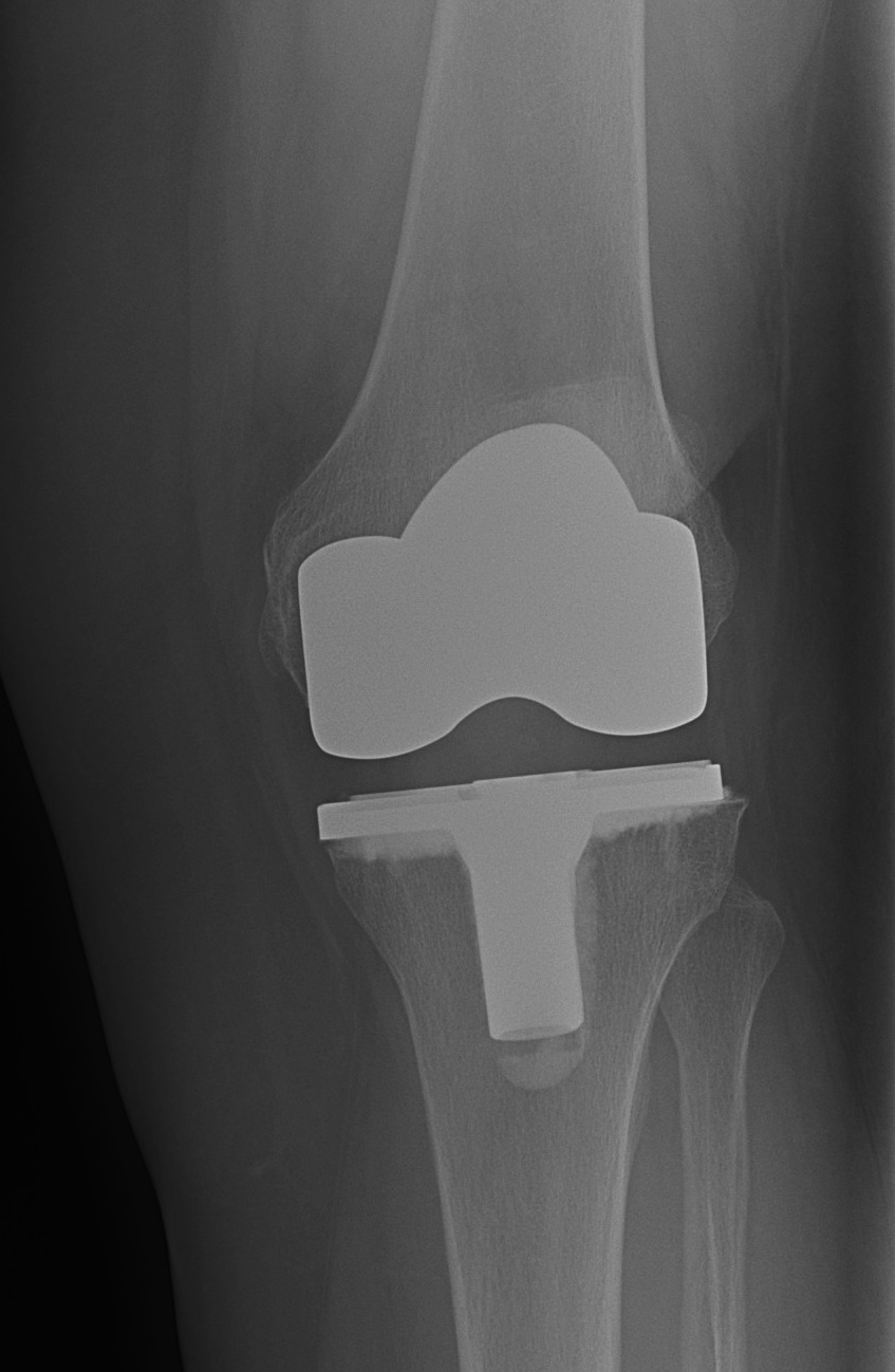 TKR Valgus Femoral Implant